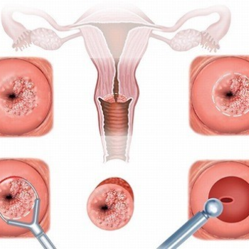 DỊCH VỤ ĐỐT ĐIỆN CỔ TỬ CUNG CHÂU LÊ